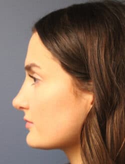 after rhinoplasty