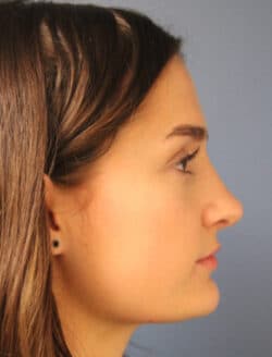 after rhinoplasty