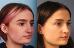 before and after rhinoplasty