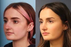 before and after rhinoplasty