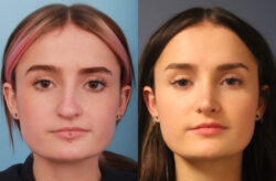 before and after rhinoplasty