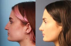 before and after rhinoplasty