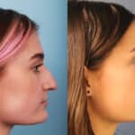 rhinoplasty-merged-4