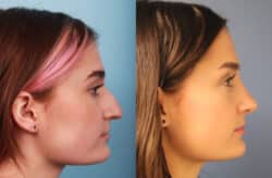 before and after rhinoplasty