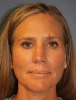 after rhinoplasty