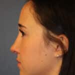 rhinoplasty-after-5