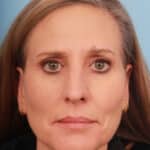 rhinoplasty-before