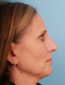 before rhinoplasty