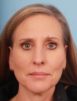 before rhinoplasty