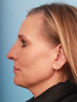 before rhinoplasty