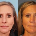 rhinoplasty-merged