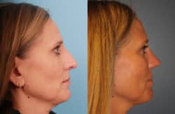 before and after rhinoplasty