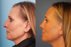 before and after rhinoplasty