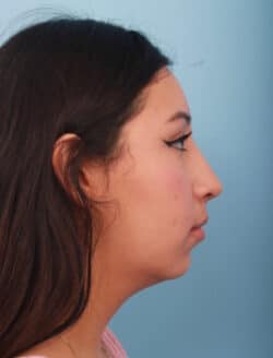 after rhinoplasty