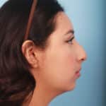 rhinoplasty-before-6