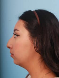 before rhinoplasty