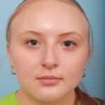 rhinoplasty-before-8