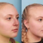 rhinoplasty-merged-10