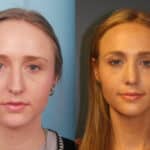 rhinoplasty-merged