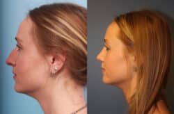 before and after rhinoplasty