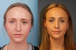 before and after rhinoplasty