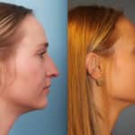 rhinoplasty-merged-3