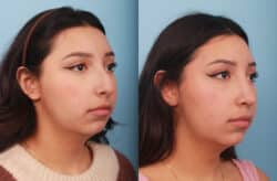 before and after rhinoplasty