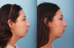 before and after rhinoplasty