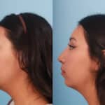 rhinoplasty-merged-7