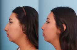 before and after rhinoplasty