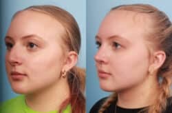 before and after rhinoplasty
