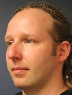 before rhinoplasty