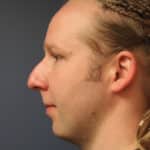 rhinoplasty-before-2