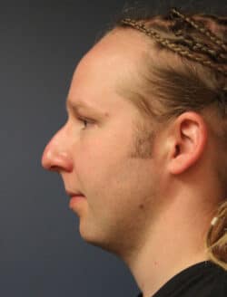 before rhinoplasty