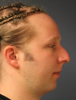 before rhinoplasty