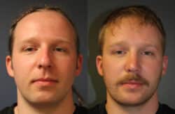 before and after rhinoplasty