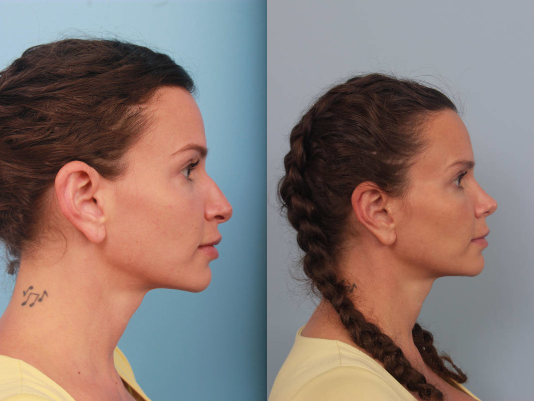 before_after_img