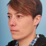 blepharoplasty-after-1
