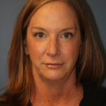 blepharoplasty-after-2