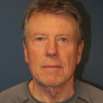 blepharoplasty-after-5