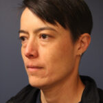 blepharoplasty-before-1