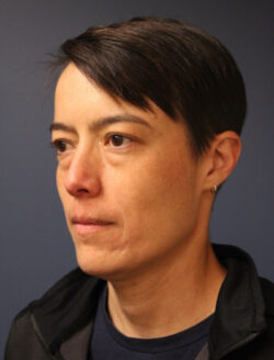 before blepharoplasty