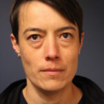 blepharoplasty-before