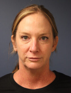 before blepharoplasty