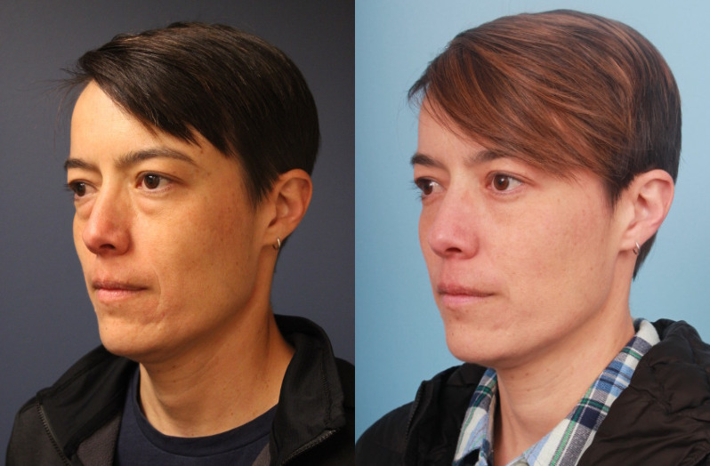 before_after_img