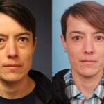 blepharoplasty-merged
