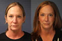 before and after blepharoplasty