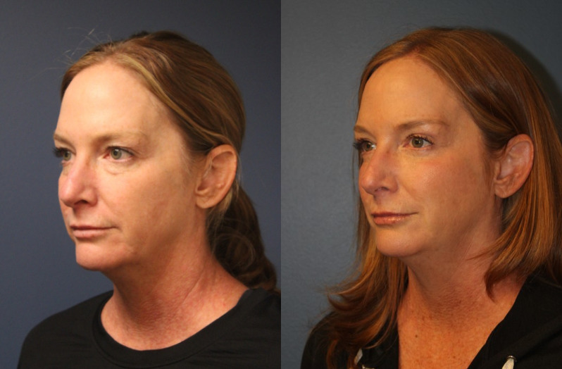 before_after_img