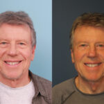 blepharoplasty-merged-4