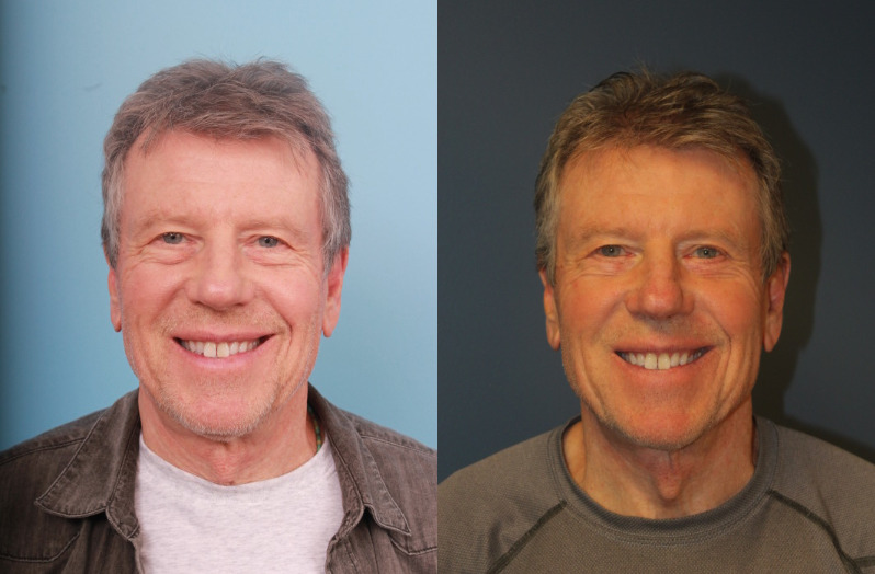 before_after_img